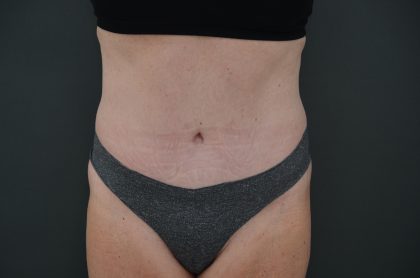 Abdominoplasty Before & After Patient #3938