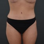 Abdominoplasty Before & After Patient #3941