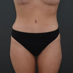 Abdominoplasty Before & After Patient #3941