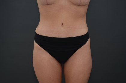 Abdominoplasty Before & After Patient #3941