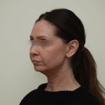 Facelift Before & After Patient #3934