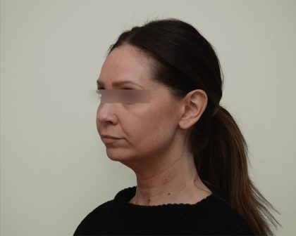 Facelift Before & After Patient #3934