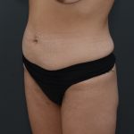 Abdominoplasty Before & After Patient #3941