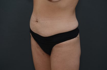 Abdominoplasty Before & After Patient #3941