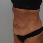 Abdominoplasty Before & After Patient #3932