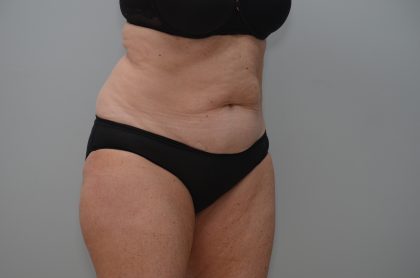 Abdominoplasty Before & After Patient #3933