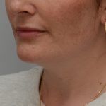Neck Liposuction Before & After Patient #3935