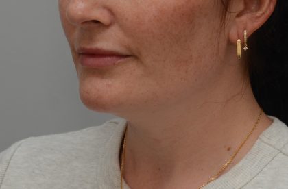 Neck Liposuction Before & After Patient #3935