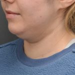 Facetite Before & After Patient #3937