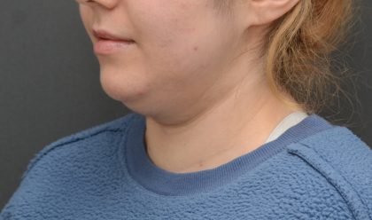 Facetite Before & After Patient #3937