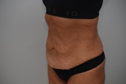 Abdominoplasty Before & After Patient #3932