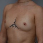 Breast Augmentation Before & After Patient #3936