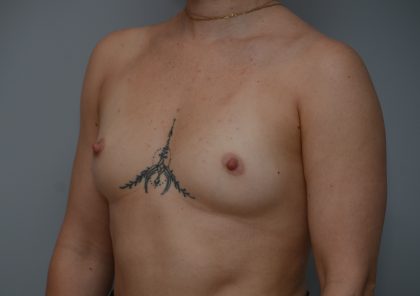 Breast Augmentation Before & After Patient #3936