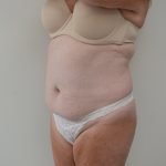 Abdominoplasty Before & After Patient #3938