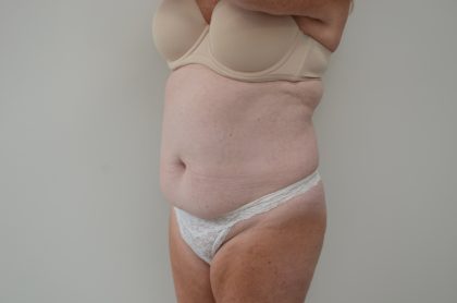 Abdominoplasty Before & After Patient #3938