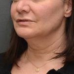 Mini Facelift Before & After Patient #3942