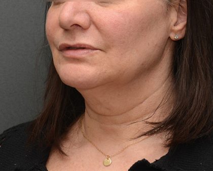 Mini Facelift Before & After Patient #3942