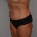 Abdominoplasty Before & After Patient #3932