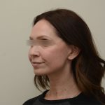 Facelift Before & After Patient #3934