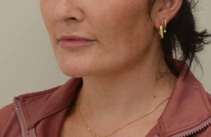 Neck Liposuction Before & After Patient #3935