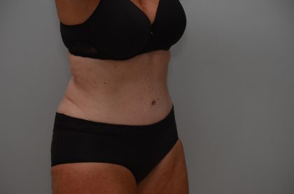 Abdominoplasty Before & After Patient #3933
