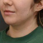 Facetite Before & After Patient #3937
