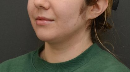 Facetite Before & After Patient #3937