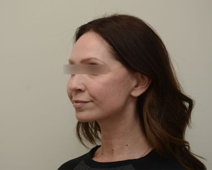 Facelift Before & After Patient #3934