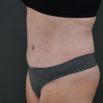 Abdominoplasty Before & After Patient #3938