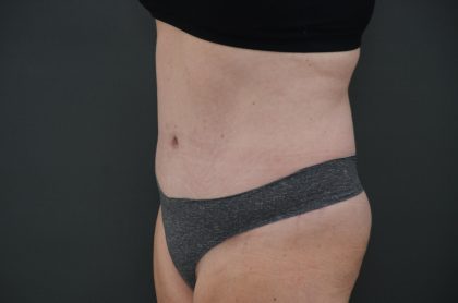 Abdominoplasty Before & After Patient #3938