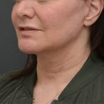 Mini Facelift Before & After Patient #3942