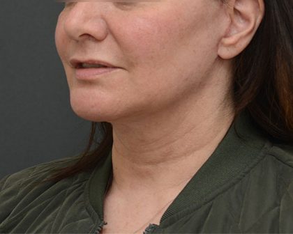 Mini Facelift Before & After Patient #3942
