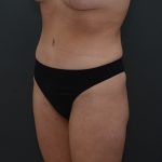 Abdominoplasty Before & After Patient #3941