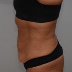 Abdominoplasty Before & After Patient #3932