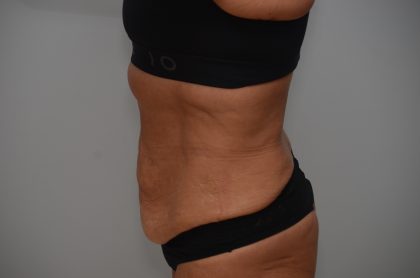 Abdominoplasty Before & After Patient #3932