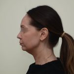 Facelift Before & After Patient #3934