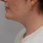 Neck Liposuction Before & After Patient #3935