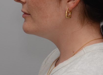 Neck Liposuction Before & After Patient #3935