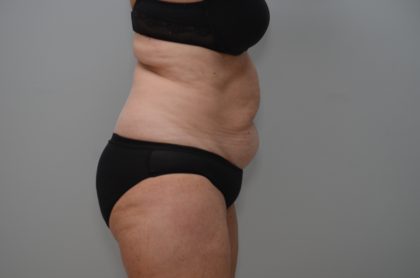 Abdominoplasty Before & After Patient #3933