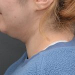 Facetite Before & After Patient #3937