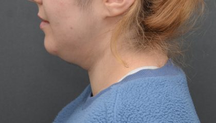Facetite Before & After Patient #3937