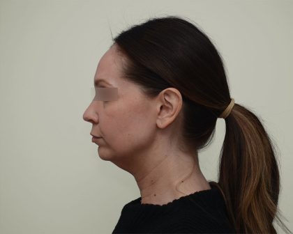 Facelift Before & After Patient #3934
