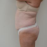 Abdominoplasty Before & After Patient #3938