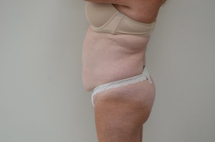Abdominoplasty Before & After Patient #3938