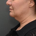 Mini Facelift Before & After Patient #3942