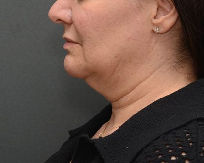 Mini Facelift Before & After Patient #3942