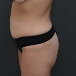 Abdominoplasty Before & After Patient #3941