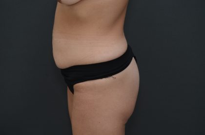 Abdominoplasty Before & After Patient #3941