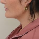 Neck Liposuction Before & After Patient #3935