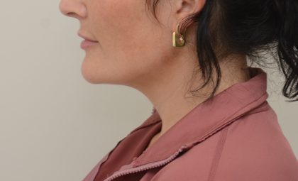 Neck Liposuction Before & After Patient #3935